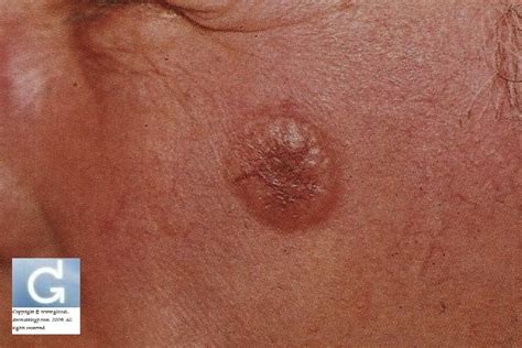 Basal Cell Carcinoma Photos Globale Dermatologie