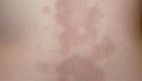 morphea symptoms causes and treatment