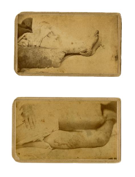 At Auction Civil War Cdv 2 More Views Of Gruesome Wounds