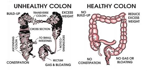 colonic qanda details on colon hydrotherapy and its benefits