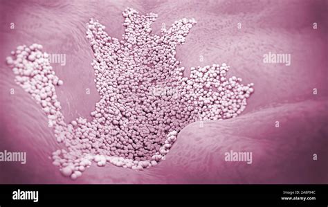 Infección Cutánea Micótica Ilustración Fotografía De Stock Alamy