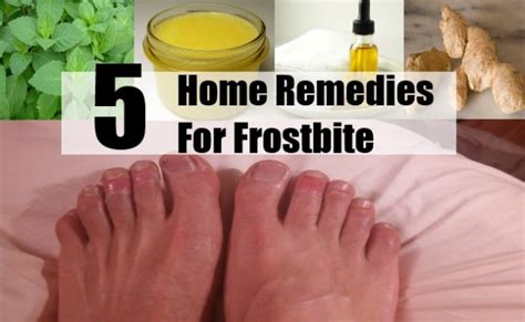 5 Home Remedies To Relieve Frostbite Page 2 Of 4