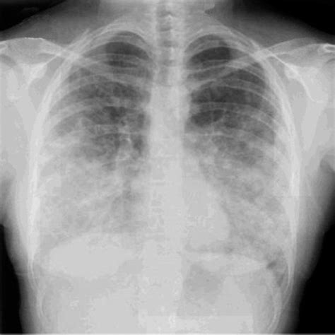 Posterior Anterior Pa Chest Radiograph Demonstrating Bilateral