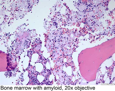 Pathology Outlines Primary Amyloidosis
