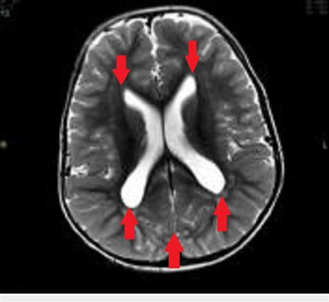 Ct Scan Brain Showing Megalencephaly With Enlarged Ventricles And