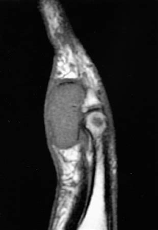 Giant Cell Tumor Of Tendon Sheath Hand Orthobullets