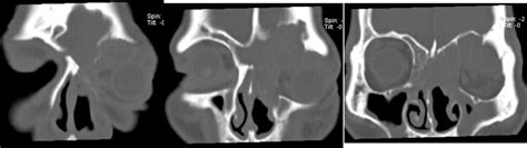 Sinonasal Inverted Papilloma Radiology Cases