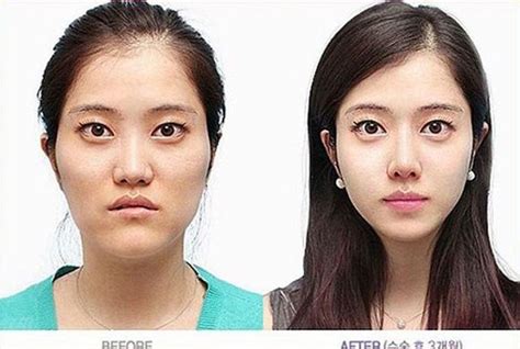 23 Most Extreme South Korean Plastic Surgery Before And After Photos 8