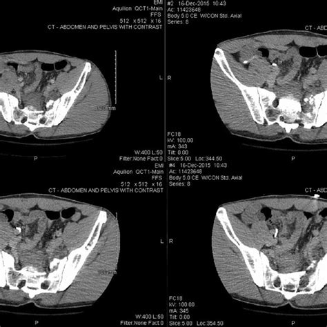 Preoperative Pelvic Computed Tomography Axial Series Download