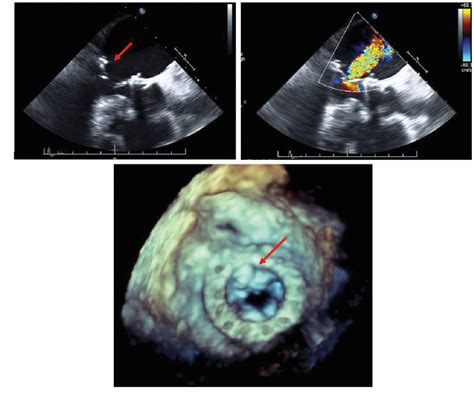 Figure 1 From Bioprosthetic Mitral Valve Dysfunction Due To Native