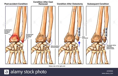 Ulnar Lower End Fracture Causes Diagnosis Treatment Rxharun
