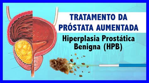 Tratamento Da Próstata Aumentada Hiperplasia Prostática Benigna Hpb