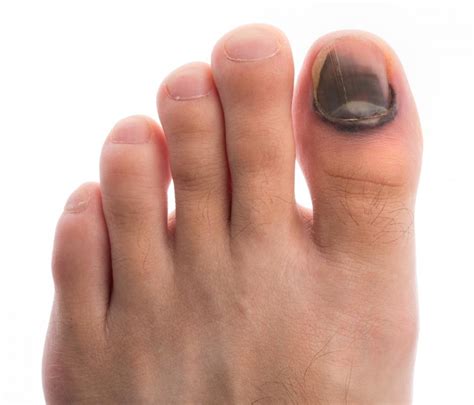 What Are The Most Common Causes Of Big Toe Pain