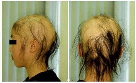 Clinical Feature On Initial Examination Bald Patches Of Varying Sizes