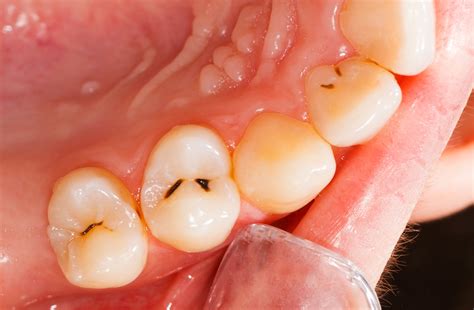 What Is Rotten Teeth, Symptoms and Treatment for Tooth Decay