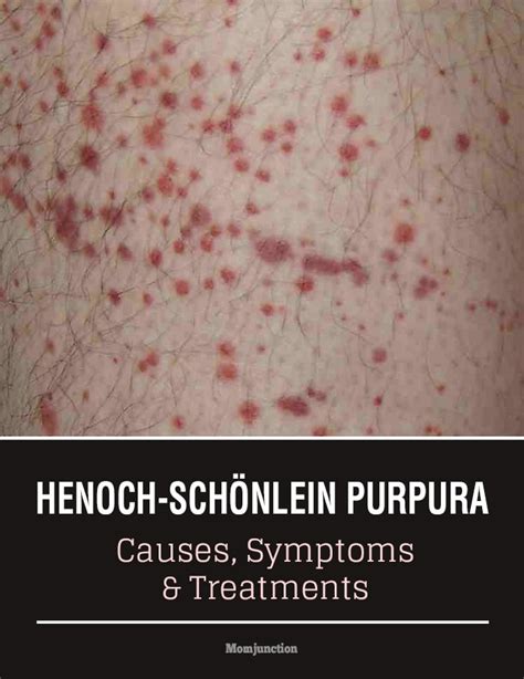 Henoch Schönlein Purpura Causes Symptoms And Treatment