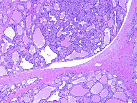 Histologically The Thyroid Gland In Graves Disease Has A Lobulated