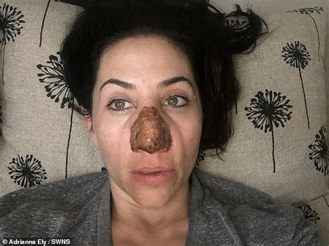 Woman Who Lived As A Recluse After Her Nose Doubled In Size Due Has The