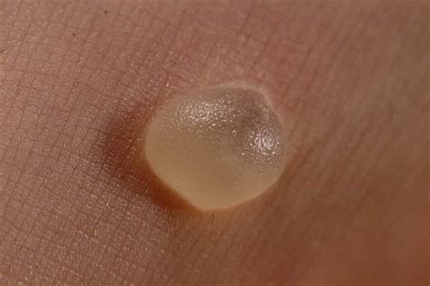 How To Get Rid Of Blisters Fast Home Remedies For Blisters