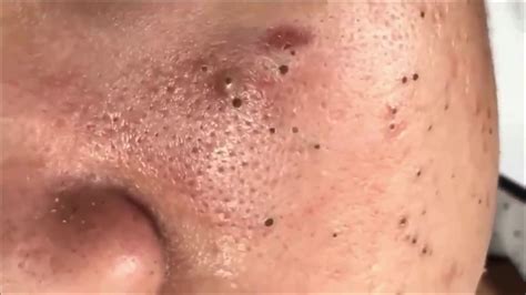 Extracting Blackheads On The Face Easy 57 Acne Treatment Youtube