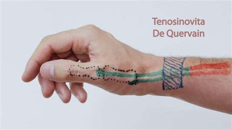 De Quervains Tenosynovitis Mississauga And Milton Chiropractor And
