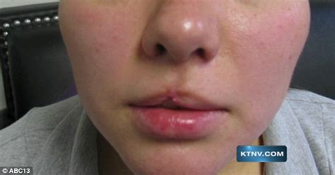 Man Bit Off Lip Of His Pregnant Girlfriend After He Was Freed From