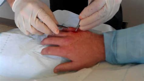 Pins Removed From Broken Finger 2 Youtube