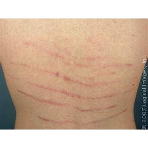 Top 95 Images Types Of Stretch Marks Pictures Full Hd 2k 4k 102023