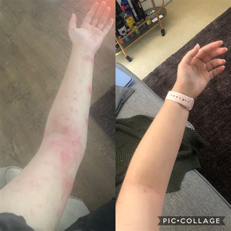 Before And After 4 Months Of Phototherapy Eczema
