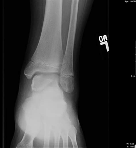 Figure Ap Radiograph Ankle Talus Osteochondritis Dissecans