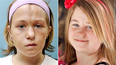 surgery saves girl s face from rare disorder