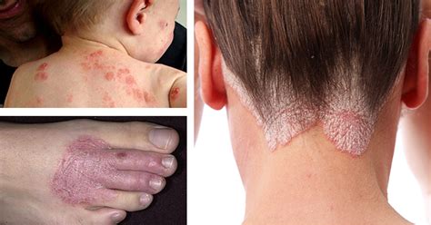 12 Natural Remedies For Eczema Rashes And A Range Of Persistent Skin Conditions Healthy Food