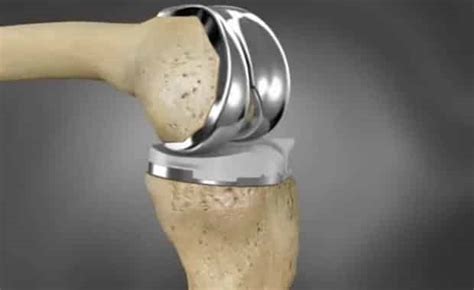 Choosing A Knee Implant Prosthesis