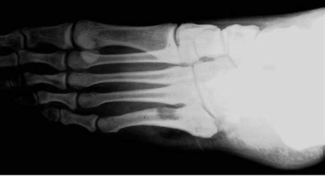 Figure 3 From Osteoid Osteoma At The Proximal Diaphysis Of The Fifth Metatarsal Semantic Scholar