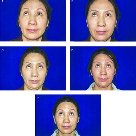 A Photograph Of A 53 Year Old Woman With Moderate Forehead Lines In Download Scientific