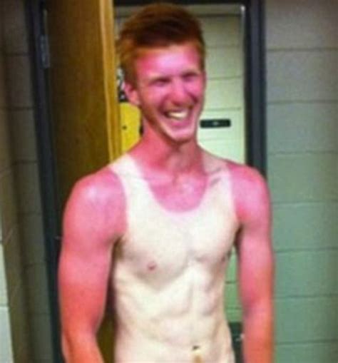 Are These The Worst Sunburn Fails Ever Daily Mail Online