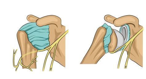 Nerve Injuries Auckland Shoulder Clinic Physio Treatment