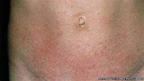Scarlet Fever Cases Rise To Weekly High In England Bbc News