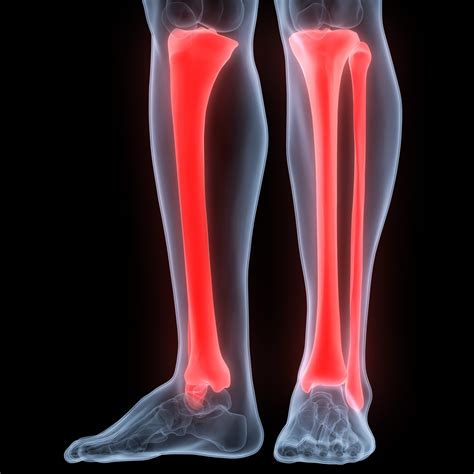 Tibial Fracture After Accident The Vrana Law Firm Personal Injury