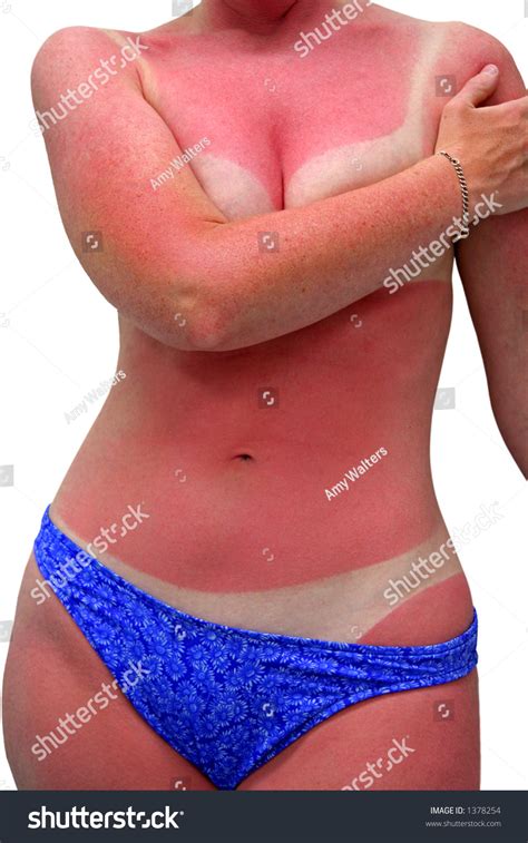 Womans Body Bad Case Sunburn Isolated Stock Photo 1378254 Shutterstock