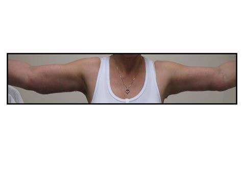 9 Best Images About Arm Lifts Brachioplasty On Pinterest Before And