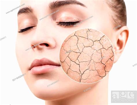 Zoom Circle Shows Dry Facial Skin Before Moistening Dry Skin Concept