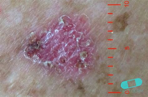 Online Dermatology Basal Cell Carcinoma Basal Cell Skin Cancer Bcc