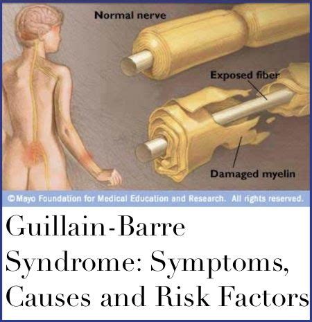 Guillain Barre Syndrome Symptoms Causes And Risk Factors Guillain