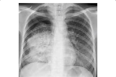 Chest X Ray Showing Dense Homogenous Opacity In Right Middle And Lower Download Scientific