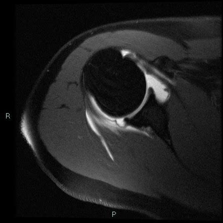 Posterosuperior Impingement Of The Shoulder Radiology Reference