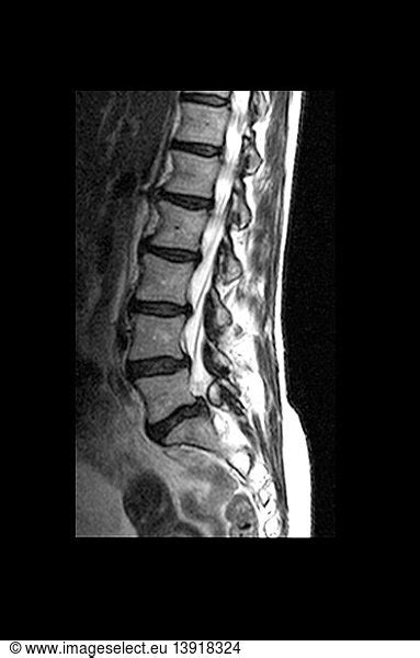 Mri Of Lumbar Spine With L5s1 Synovial Cyst Mri Of Lumbar Spine With