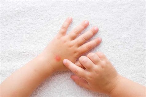 5 Effective Tips To Treat Mosquito Bites In Toddlers