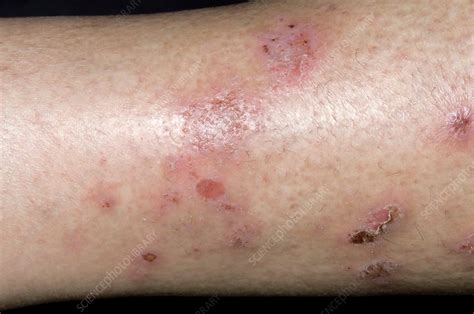 Spongiotic Dermatitis On The Leg Stock Image C0085601 Science
