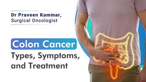 Colon Cancer Different Types Symptoms And How Its Treated